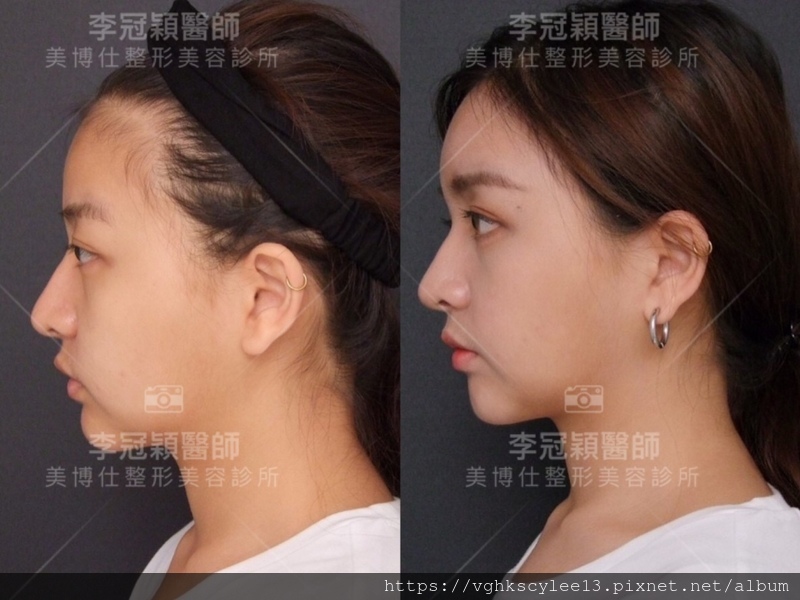 妳的豐額是哪一款的？雕塑輪廓額、假體凸額還是注射膨額？眉骨的