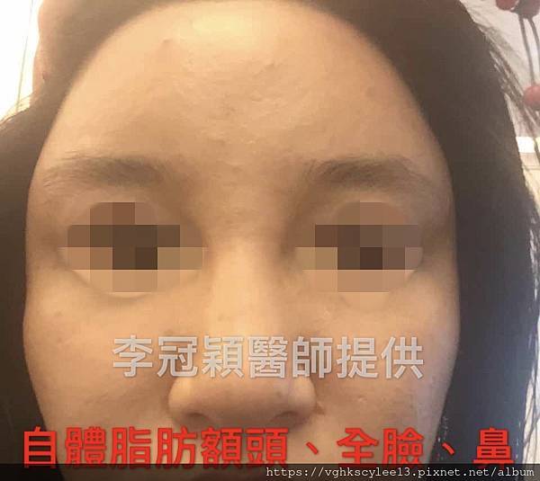 還在注射豐額頭嗎? 微創內視鏡精準豐額頭(墊額頭)不再讓妳掀 還在注射豐額頭嗎? 微創內視鏡精準豐額頭(墊額頭)不再讓妳掀