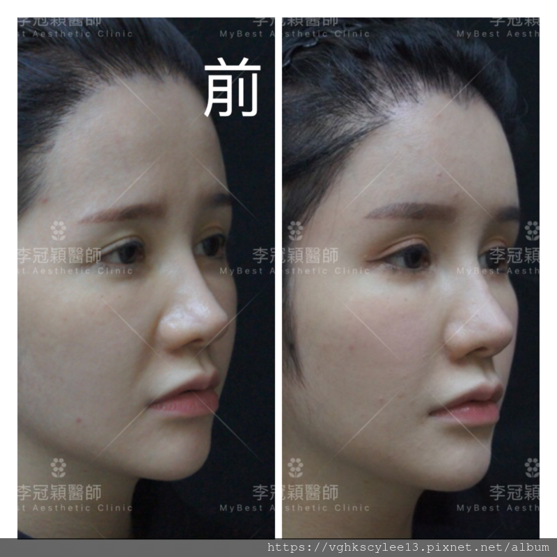 妳的豐額是哪一款的？雕塑輪廓額、假體凸額還是注射膨額？眉骨的