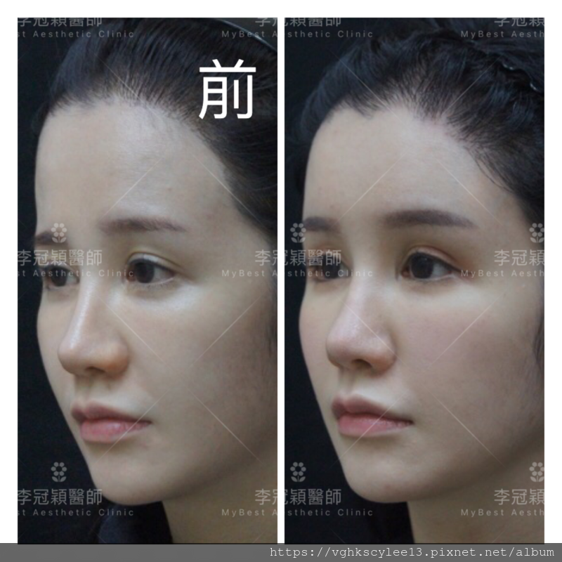 妳的豐額是哪一款的？雕塑輪廓額、假體凸額還是注射膨額？眉骨的