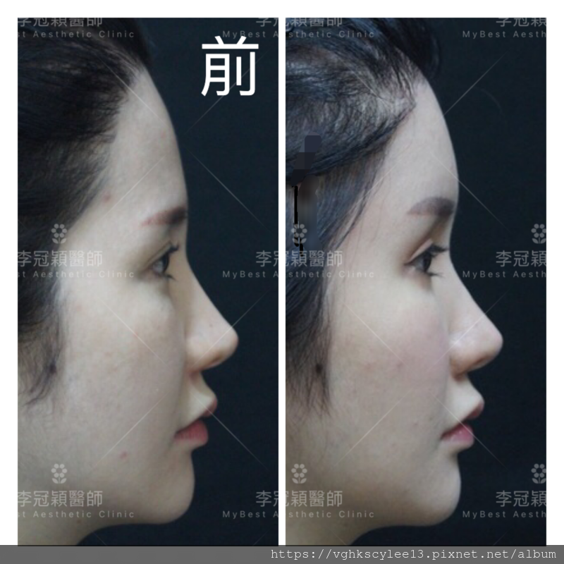 妳的豐額是哪一款的？雕塑輪廓額、假體凸額還是注射膨額？眉骨的