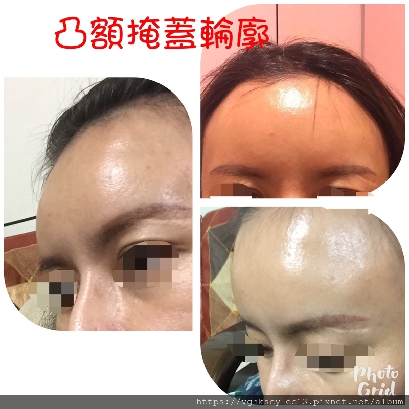 妳的豐額是哪一款的？雕塑輪廓額、假體凸額還是注射膨額？眉骨的