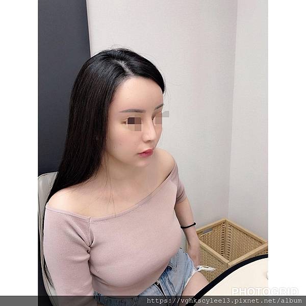 還在注射豐額頭嗎? 微創內視鏡精準豐額頭(墊額頭)不再讓妳掀 還在注射豐額頭嗎? 微創內視鏡精準豐額頭(墊額頭)不再讓妳掀