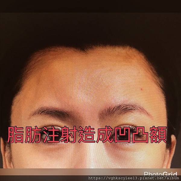 還在注射豐額頭嗎? 微創內視鏡精準豐額頭(墊額頭)不再讓妳掀 還在注射豐額頭嗎? 微創內視鏡精準豐額頭(墊額頭)不再讓妳掀