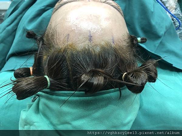 除了五爪釘，內視鏡還可以做到什麼整形？李醫師說說內視鏡可以結合的手術！