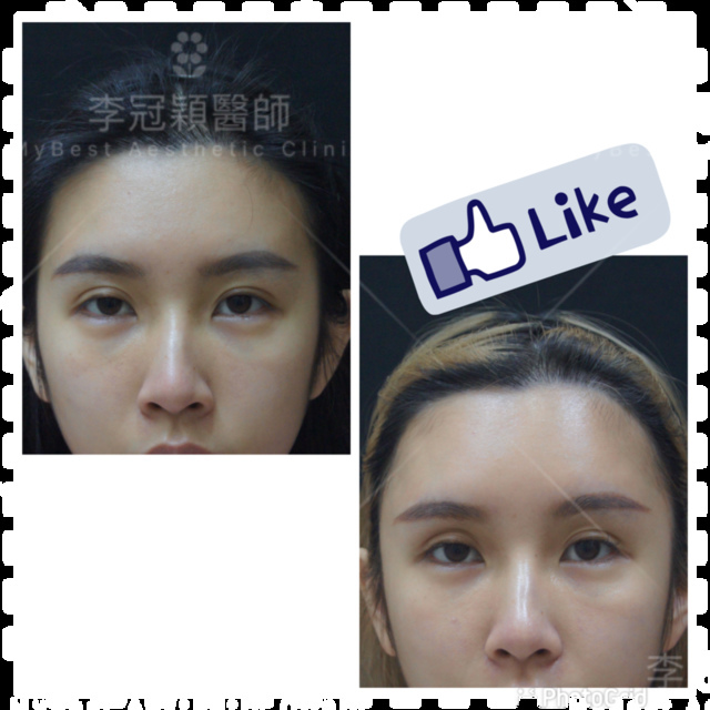 還在注射豐額頭嗎? 微創內視鏡精準豐額頭(墊額頭)不再讓妳掀 IMG_5035.PNG - 墊額頭
