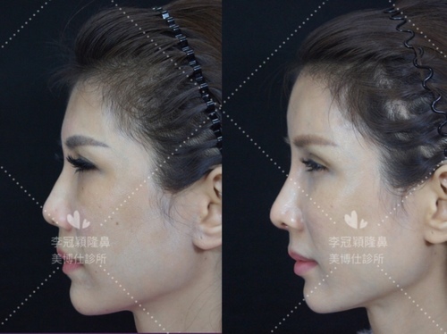 還在注射豐額頭嗎? 微創內視鏡精準豐額頭(墊額頭)不再讓妳掀 還在注射豐額頭嗎? 微創內視鏡精準豐額頭(墊額頭)不再讓妳掀