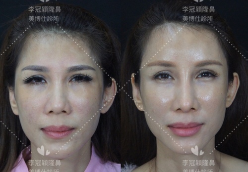 還在注射豐額頭嗎? 微創內視鏡精準豐額頭(墊額頭)不再讓妳掀 還在注射豐額頭嗎? 微創內視鏡精準豐額頭(墊額頭)不再讓妳掀