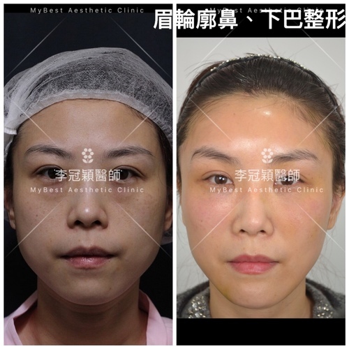 IMG_5560.JPG - 墊額頭