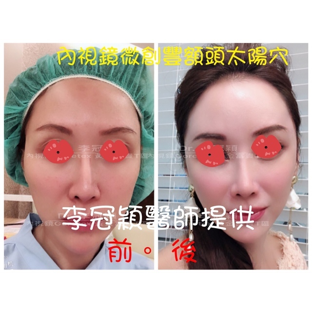 還在注射豐額頭嗎? 微創內視鏡精準豐額頭(墊額頭)不再讓妳掀 還在注射豐額頭嗎? 微創內視鏡精準豐額頭(墊額頭)不再讓妳掀