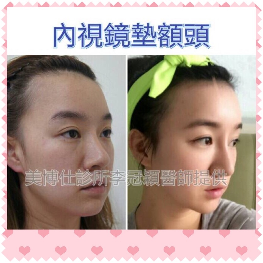 Goretex豐額手術：五年穩定性效果分析