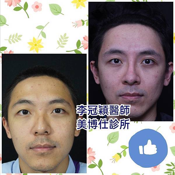 還在注射豐額頭嗎? 微創內視鏡精準豐額頭(墊額頭)不再讓妳掀 還在注射豐額頭嗎? 微創內視鏡精準豐額頭(墊額頭)不再讓妳掀