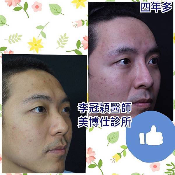 還在注射豐額頭嗎? 微創內視鏡精準豐額頭(墊額頭)不再讓妳掀 還在注射豐額頭嗎? 微創內視鏡精準豐額頭(墊額頭)不再讓妳掀