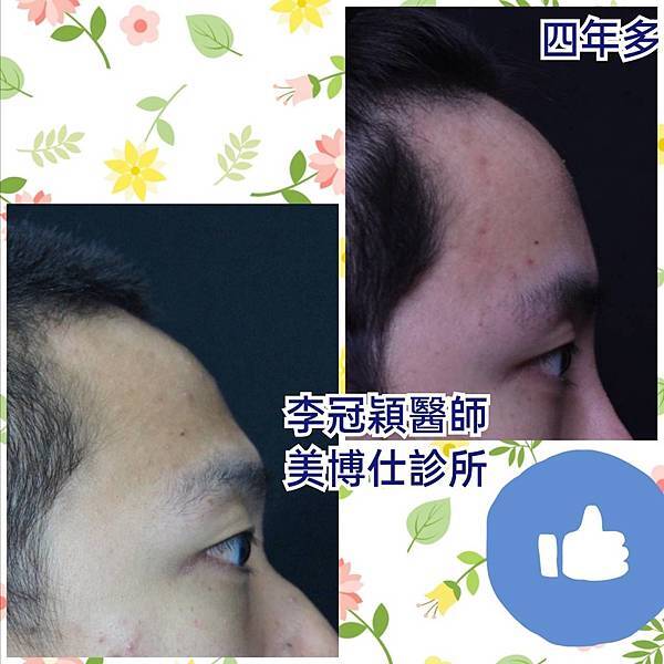 還在注射豐額頭嗎? 微創內視鏡精準豐額頭(墊額頭)不再讓妳掀 還在注射豐額頭嗎? 微創內視鏡精準豐額頭(墊額頭)不再讓妳掀