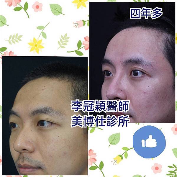 還在注射豐額頭嗎? 微創內視鏡精準豐額頭(墊額頭)不再讓妳掀 還在注射豐額頭嗎? 微創內視鏡精準豐額頭(墊額頭)不再讓妳掀