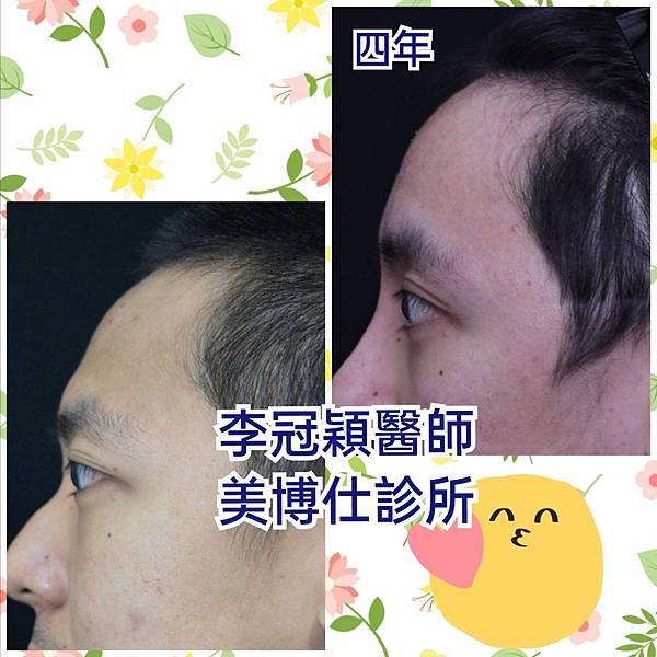 還在注射豐額頭嗎? 微創內視鏡精準豐額頭(墊額頭)不再讓妳掀 還在注射豐額頭嗎? 微創內視鏡精準豐額頭(墊額頭)不再讓妳掀