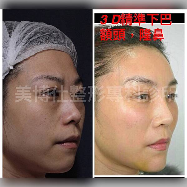 墊下巴手術