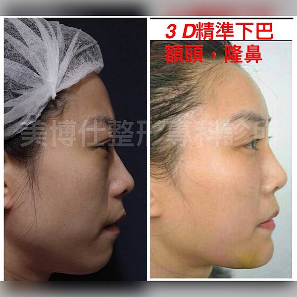墊下巴手術