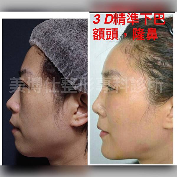 墊下巴手術