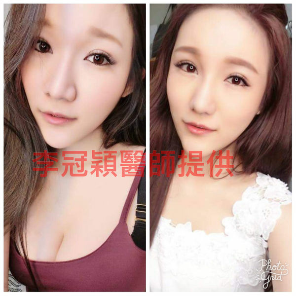 還在注射豐額頭嗎? 微創內視鏡精準豐額頭(墊額頭)不再讓妳掀 還在注射豐額頭嗎? 微創內視鏡精準豐額頭(墊額頭)不再讓妳掀