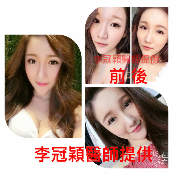 還在注射豐額頭嗎? 微創內視鏡精準豐額頭(墊額頭)不再讓妳掀 還在注射豐額頭嗎? 微創內視鏡精準豐額頭(墊額頭)不再讓妳掀