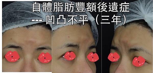 還在注射豐額頭嗎? 微創內視鏡精準豐額頭(墊額頭)不再讓妳掀 還在注射豐額頭嗎? 微創內視鏡精準豐額頭(墊額頭)不再讓妳掀