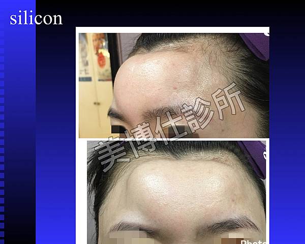 還在注射豐額頭嗎? 微創內視鏡精準豐額頭(墊額頭)不再讓妳掀 還在注射豐額頭嗎? 微創內視鏡精準豐額頭(墊額頭)不再讓妳掀