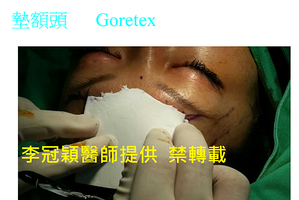 還在注射豐額頭嗎? 微創內視鏡精準豐額頭(墊額頭)不再讓妳掀 還在注射豐額頭嗎? 微創內視鏡精準豐額頭(墊額頭)不再讓妳掀