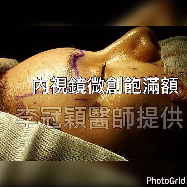 還在注射豐額頭嗎? 微創內視鏡精準豐額頭(墊額頭)不再讓妳掀 還在注射豐額頭嗎? 微創內視鏡精準豐額頭(墊額頭)不再讓妳掀