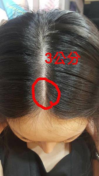 還在注射豐額頭嗎? 微創內視鏡精準豐額頭(墊額頭)不再讓妳掀 還在注射豐額頭嗎? 微創內視鏡精準豐額頭(墊額頭)不再讓妳掀