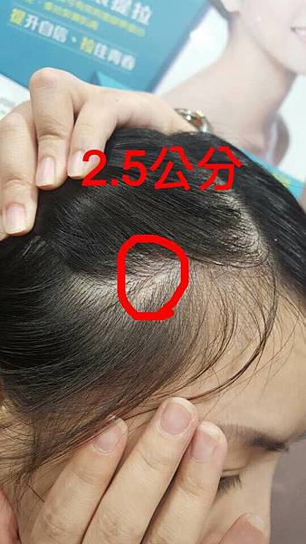 還在注射豐額頭嗎? 微創內視鏡精準豐額頭(墊額頭)不再讓妳掀 還在注射豐額頭嗎? 微創內視鏡精準豐額頭(墊額頭)不再讓妳掀