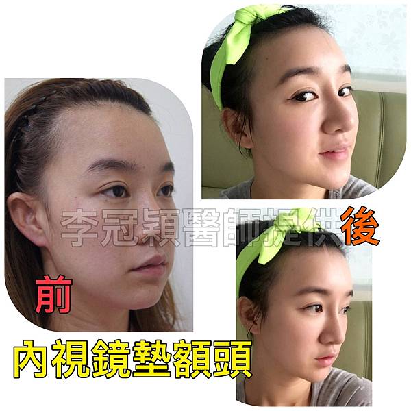 還在注射豐額頭嗎? 微創內視鏡精準豐額頭(墊額頭)不再讓妳掀 還在注射豐額頭嗎? 微創內視鏡精準豐額頭(墊額頭)不再讓妳掀