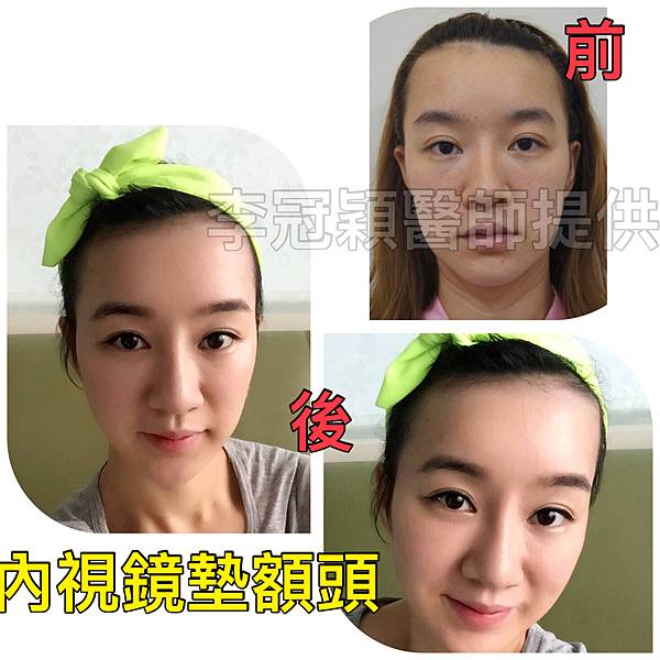 還在注射豐額頭嗎? 微創內視鏡精準豐額頭(墊額頭)不再讓妳掀 還在注射豐額頭嗎? 微創內視鏡精準豐額頭(墊額頭)不再讓妳掀