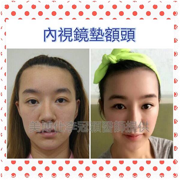 還在注射豐額頭嗎? 微創內視鏡精準豐額頭(墊額頭)不再讓妳掀 還在注射豐額頭嗎? 微創內視鏡精準豐額頭(墊額頭)不再讓妳掀