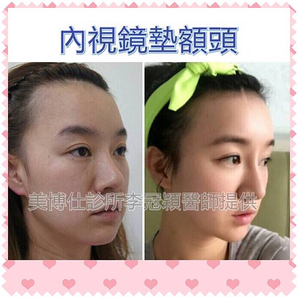 還在注射豐額頭嗎? 微創內視鏡精準豐額頭(墊額頭)不再讓妳掀 還在注射豐額頭嗎? 微創內視鏡精準豐額頭(墊額頭)不再讓妳掀