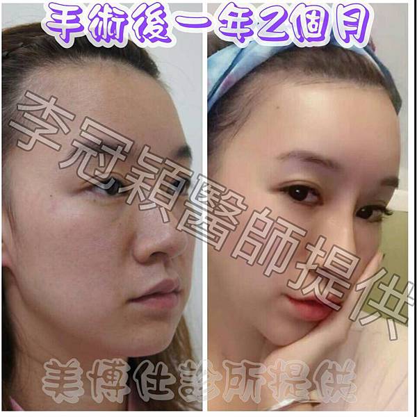 內視鏡精準豐額頭: 擁有年輕飽滿額型的秘密