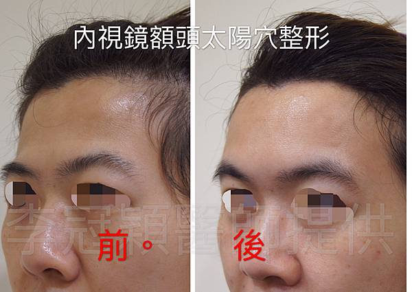 還在注射豐額頭嗎? 微創內視鏡精準豐額頭(墊額頭)不再讓妳掀 還在注射豐額頭嗎? 微創內視鏡精準豐額頭(墊額頭)不再讓妳掀