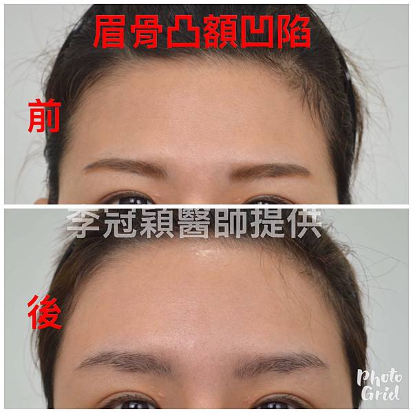 還在注射豐額頭嗎? 微創內視鏡精準豐額頭(墊額頭)不再讓妳掀 還在注射豐額頭嗎? 微創內視鏡精準豐額頭(墊額頭)不再讓妳掀