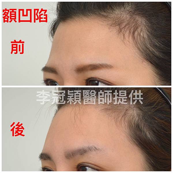 還在注射豐額頭嗎? 微創內視鏡精準豐額頭(墊額頭)不再讓妳掀 還在注射豐額頭嗎? 微創內視鏡精準豐額頭(墊額頭)不再讓妳掀