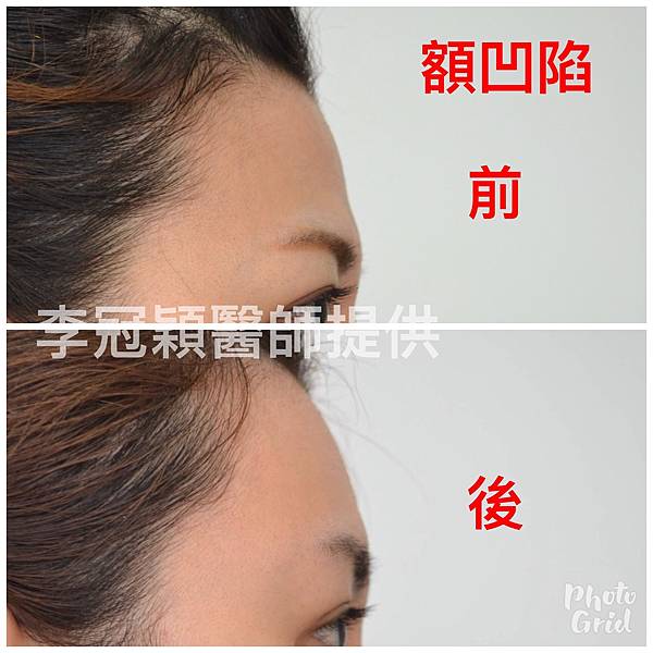 還在注射豐額頭嗎? 微創內視鏡精準豐額頭(墊額頭)不再讓妳掀 還在注射豐額頭嗎? 微創內視鏡精準豐額頭(墊額頭)不再讓妳掀