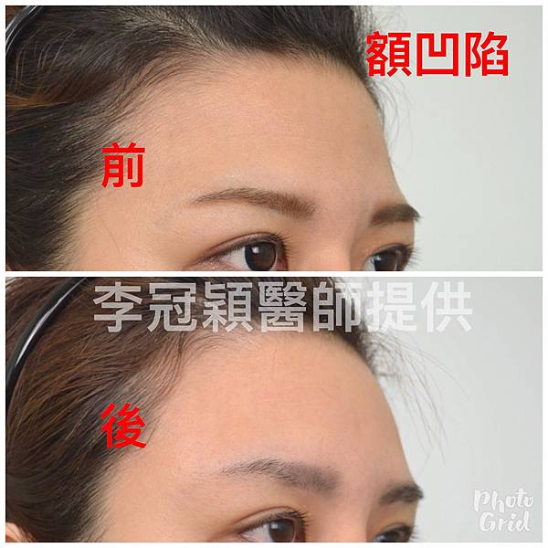 還在注射豐額頭嗎? 微創內視鏡精準豐額頭(墊額頭)不再讓妳掀 還在注射豐額頭嗎? 微創內視鏡精準豐額頭(墊額頭)不再讓妳掀