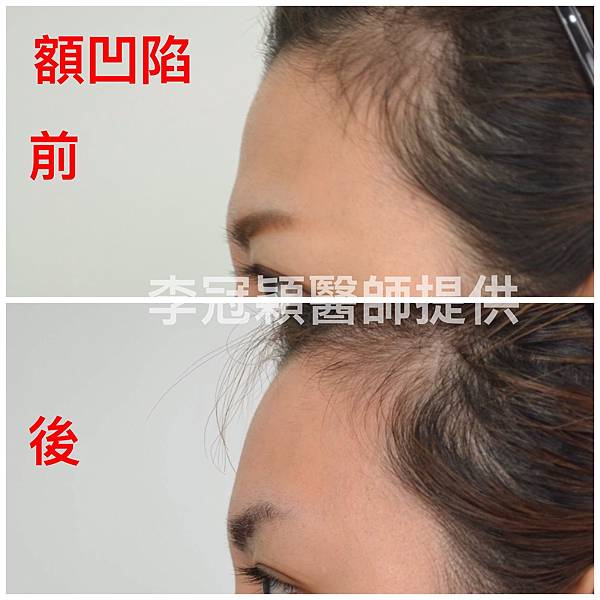 還在注射豐額頭嗎? 微創內視鏡精準豐額頭(墊額頭)不再讓妳掀 還在注射豐額頭嗎? 微創內視鏡精準豐額頭(墊額頭)不再讓妳掀