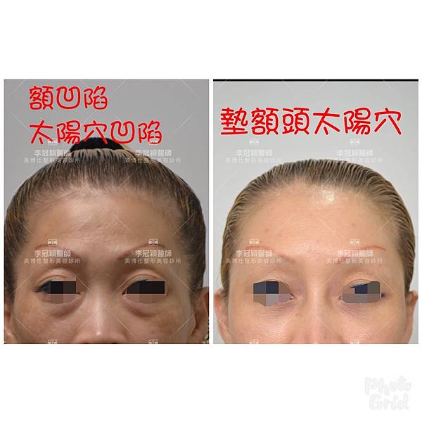 還在注射豐額頭嗎? 微創內視鏡精準豐額頭(墊額頭)不再讓妳掀 還在注射豐額頭嗎? 微創內視鏡精準豐額頭(墊額頭)不再讓妳掀