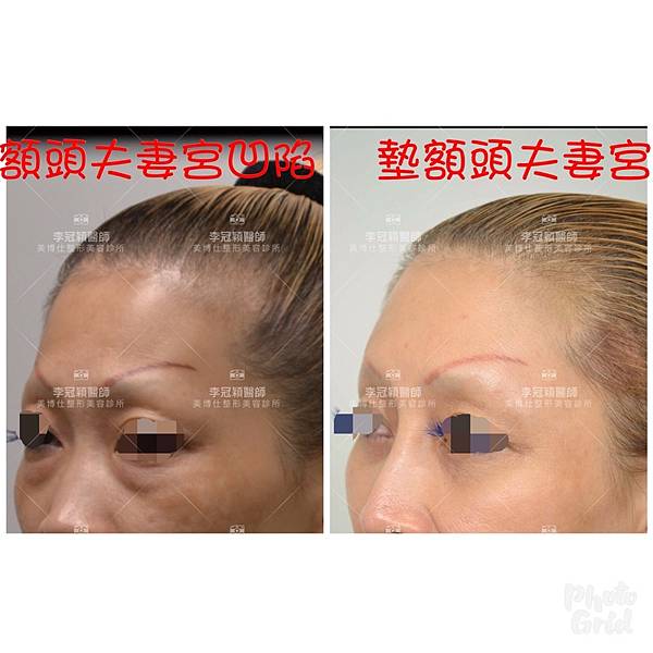 還在注射豐額頭嗎? 微創內視鏡精準豐額頭(墊額頭)不再讓妳掀 還在注射豐額頭嗎? 微創內視鏡精準豐額頭(墊額頭)不再讓妳掀