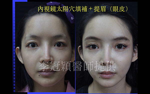 還在注射豐額頭嗎? 微創內視鏡精準豐額頭(墊額頭)不再讓妳掀 還在注射豐額頭嗎? 微創內視鏡精準豐額頭(墊額頭)不再讓妳掀
