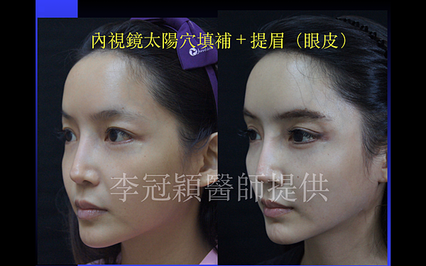 還在注射豐額頭嗎? 微創內視鏡精準豐額頭(墊額頭)不再讓妳掀 還在注射豐額頭嗎? 微創內視鏡精準豐額頭(墊額頭)不再讓妳掀