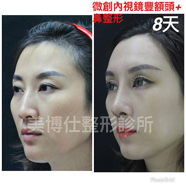 還在注射豐額頭嗎? 微創內視鏡精準豐額頭(墊額頭)不再讓妳掀 還在注射豐額頭嗎? 微創內視鏡精準豐額頭(墊額頭)不再讓妳掀