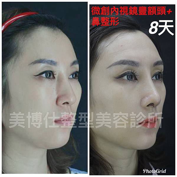 還在注射豐額頭嗎? 微創內視鏡精準豐額頭(墊額頭)不再讓妳掀 還在注射豐額頭嗎? 微創內視鏡精準豐額頭(墊額頭)不再讓妳掀