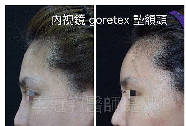 還在注射豐額頭嗎? 微創內視鏡精準豐額頭(墊額頭)不再讓妳掀 還在注射豐額頭嗎? 微創內視鏡精準豐額頭(墊額頭)不再讓妳掀