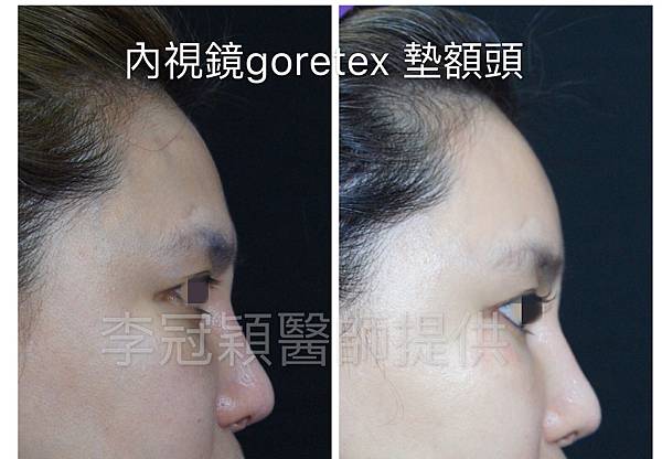 還在注射豐額頭嗎? 微創內視鏡精準豐額頭(墊額頭)不再讓妳掀 還在注射豐額頭嗎? 微創內視鏡精準豐額頭(墊額頭)不再讓妳掀